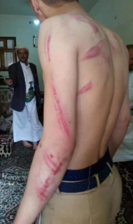 صنعاء..طالبان يتعرضان لتعذيب جسدي وحشي من قبل مدير مدرسة الشعب